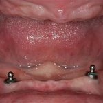 2 implants on the lower jaw for fixing a removable denture