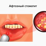 Афтозный стоматит в картинках