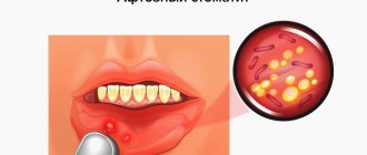 Aphthous stomatitis in pictures
