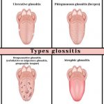 aphthous stomatitis - types