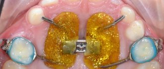 Marco Rosa apparatus for maxillary expansion