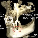 Атрофия костной ткани при сахарном диабете. Пациент Немецкого имплантологического центра. Лечащий врач - Дахкильгов Магомед Уматгиреевич