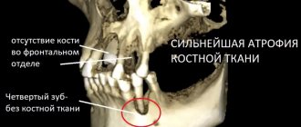 Bone atrophy in diabetes mellitus. Patient of the German Implant Center. Attending physician - Dakhkilgov Magomed Umatgireevich 