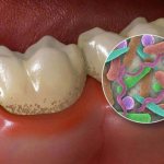 Oral bacteria cause inflammation