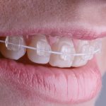 White arch braces