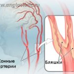 Plaques in the carotid arteries are the most common cause of ischemic stroke