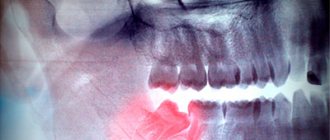 Боль из-за того, что режется зуб мудрости - Стоматология Линия Улыбки