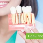 pain after dental implantation