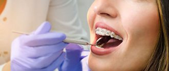 Braces for canines - Dentistry Line Smiles