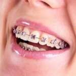 Braces