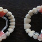 clasp denture on the upper and lower jaw