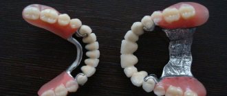 clasp denture on the upper and lower jaw