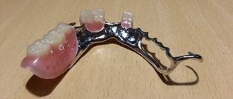 Clasp prosthesis with locks