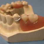 Clasp denture with clasps