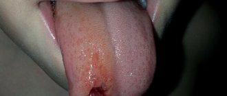 Частой причиной боли является повреждение кончика языка