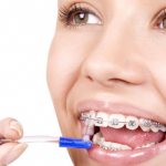 Cleaning braces with a brush