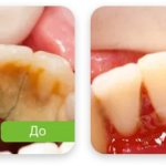 teeth cleaning photo before after in ROOTT