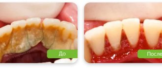 teeth cleaning photo before after in ROOTT