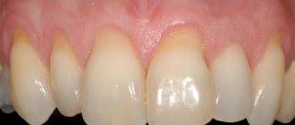 What to do if the gum has risen above the tooth. When you can&#39;t do without surgery 