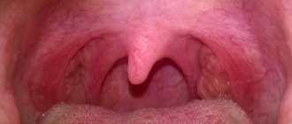 What to do if the root of the tongue hurts when swallowing, why does this happen?