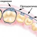 What is a braces system?