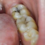 what is caries and how does it develop?