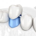 What awaits the patient after endodontic therapy?