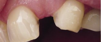 Dental defects