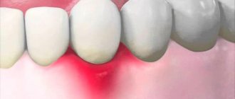 Gums hurt between teeth