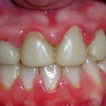 Gums with gingivitis