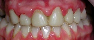 Gums with gingivitis