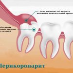 Диагностика и лечение перикоронита