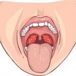 Diagnosis of tonsil cysts