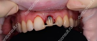 tooth extrusion