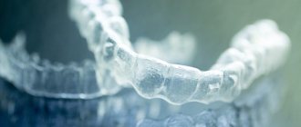 aligners for teeth straightening