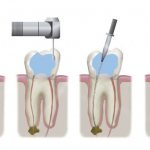 Эндодонтическое лечение корневых каналов
