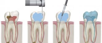 Эндодонтическое лечение корневых каналов