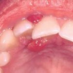 Epulis can often be confused with gingivitis