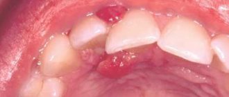 Epulis can often be confused with gingivitis