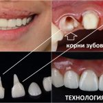 Если остался корень зуба, то очень хорошо себя зарекомендовала при восстановлении зуба технология CEREC