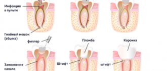 Stages of restoring a tooth on a pin