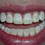 Fluorosis on teeth