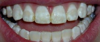 Fluorosis on teeth