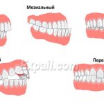 Forms of malocclusion