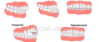 Forms of malocclusion