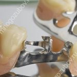 photo of a clasp denture with attachments