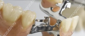 photo of a clasp denture with attachments