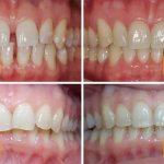 Photos before and after treatment with aligners