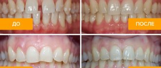 Photos before and after treatment with aligners