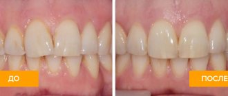 Photos before and after treatment with lingual braces